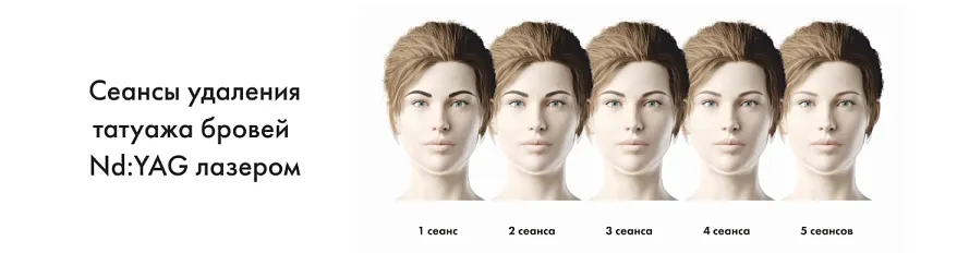 Удаление перманентного макияжа что это такое?